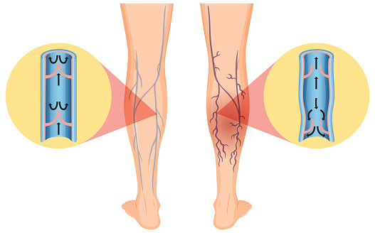 Human legs with varicose vein illustration