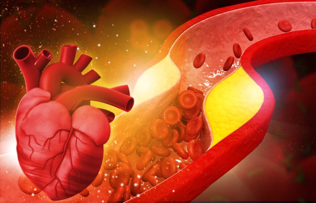 Blocked artery showing cholesterol plaque and heart disease risk