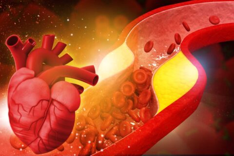 Blocked artery showing cholesterol plaque and heart disease risk